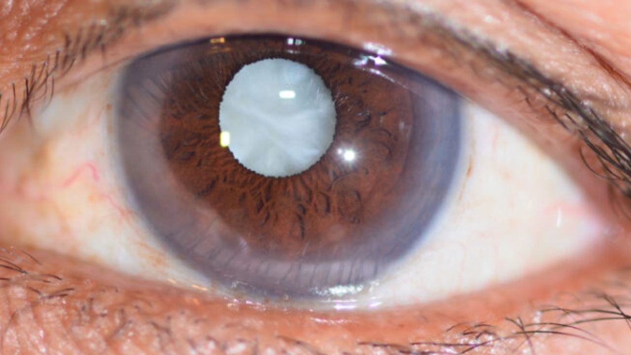 Diabetic Cataract Problem: డయాబెటిక్ పేషెంట్లలో కంటిశుక్లం ఎంత వరకు ప్రభావితం అవుతుందంటే? Diabetic Cataract Problem: డయాబెటిక్ పేషెంట్లలో కంటిశుక్లం ఎంత వరకు ప్రభావితం అవుతుందంటే?
