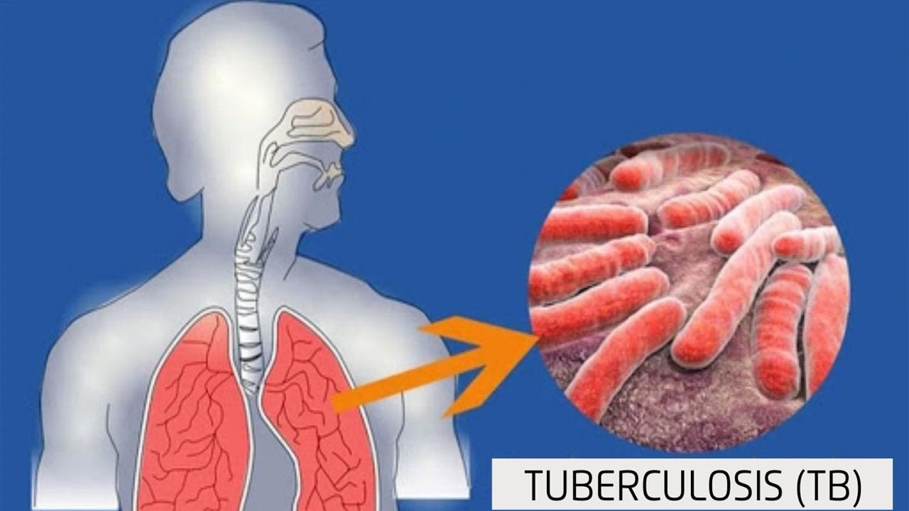 TB Disease: ప్రమాదకరంగా మారుతున్న ఈ అంటు వ్యాధి.. ప్రతి ఏడాది లక్షల్లో మృత్యువాత TB Disease: ప్రమాదకరంగా మారుతున్న ఈ అంటు వ్యాధి.. ప్రతి ఏడాది లక్షల్లో మృత్యువాత