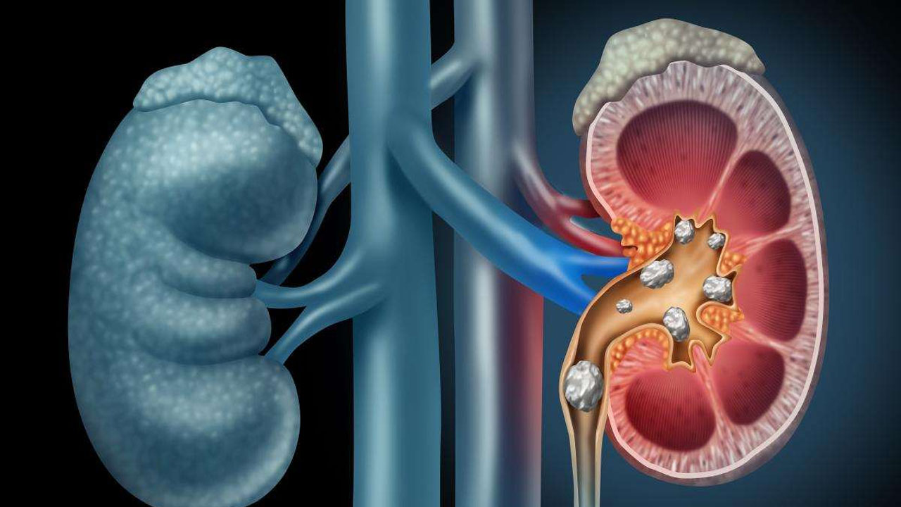 Kidney Stones: కిడ్నీలో రాళ్లు ఉండి ఇవి తిన్నారో.. ఇక దబిడి దిబిడే Kidney Stones: కిడ్నీలో రాళ్లు ఉండి ఇవి తిన్నారో.. ఇక దబిడి దిబిడే