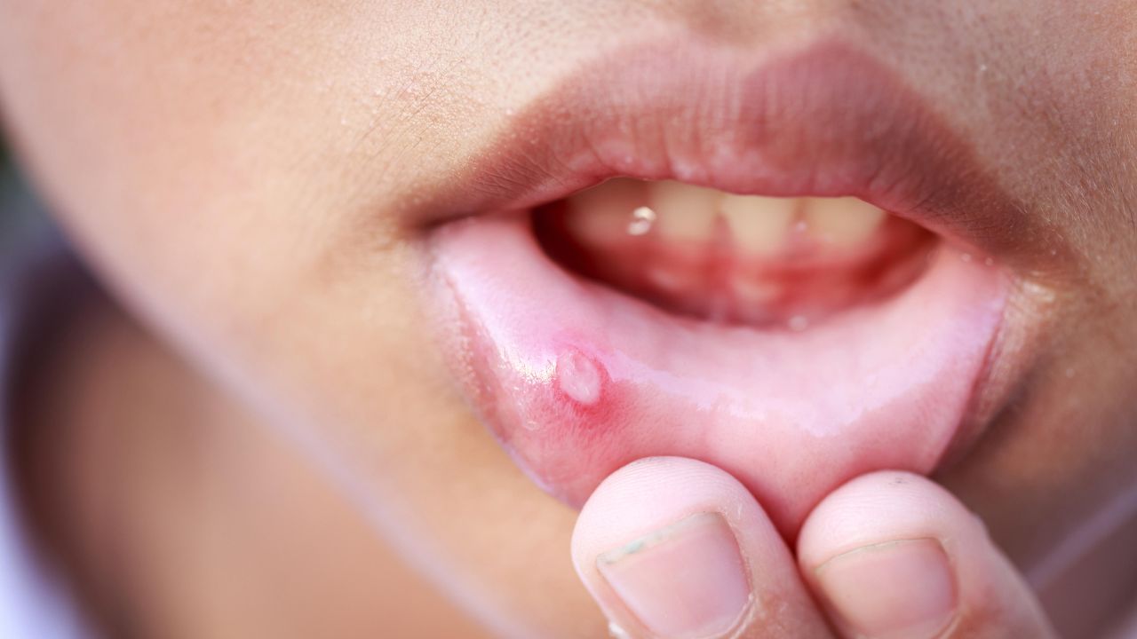 Mouth Ulcers: నోటి పుండ్లు ఎందుకు వస్తాయి? వస్తే ఎలా తగ్గించుకోవాలంటే! Mouth Ulcers: నోటి పుండ్లు ఎందుకు వస్తాయి? వస్తే ఎలా తగ్గించుకోవాలంటే!